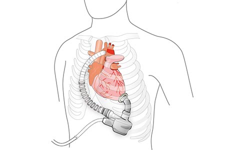 植込み型補助人工心臓