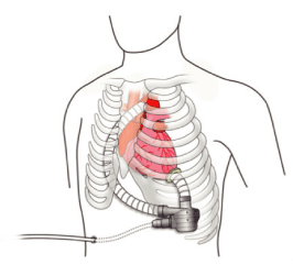 植込み型補助人工心臓