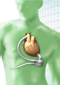 Evaheart_2 埋込み型左心補助人工心臓 EVAHEART (2)